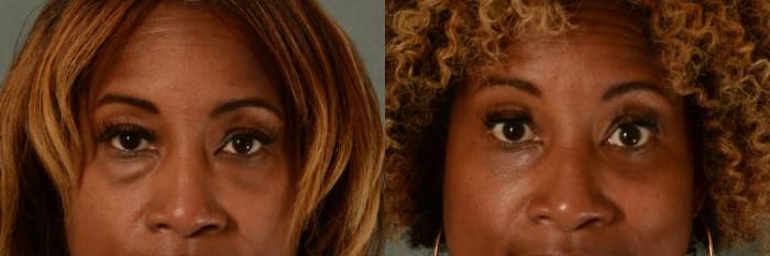 Before & After Eyelid Surgery (Blepharoplasty) Case 413 View #1 View in Tallahassee, FL