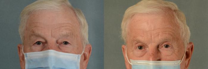 Before & After Eyelid Surgery (Blepharoplasty) Case 426 View #1 View in Tallahassee, FL