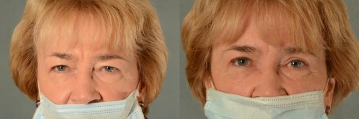 Before & After Eyelid Surgery (Blepharoplasty) Case 429 View #1 View in Tallahassee, FL
