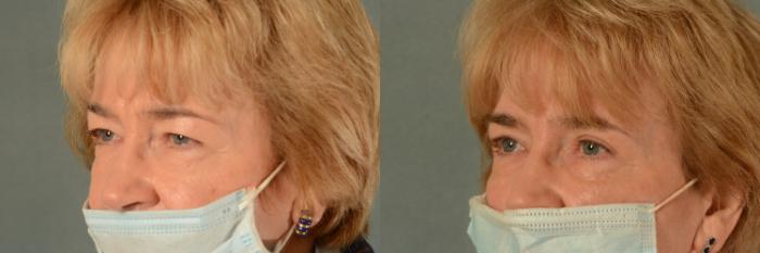 Before & After Eyelid Surgery (Blepharoplasty) Case 429 View #2 View in Tallahassee, FL