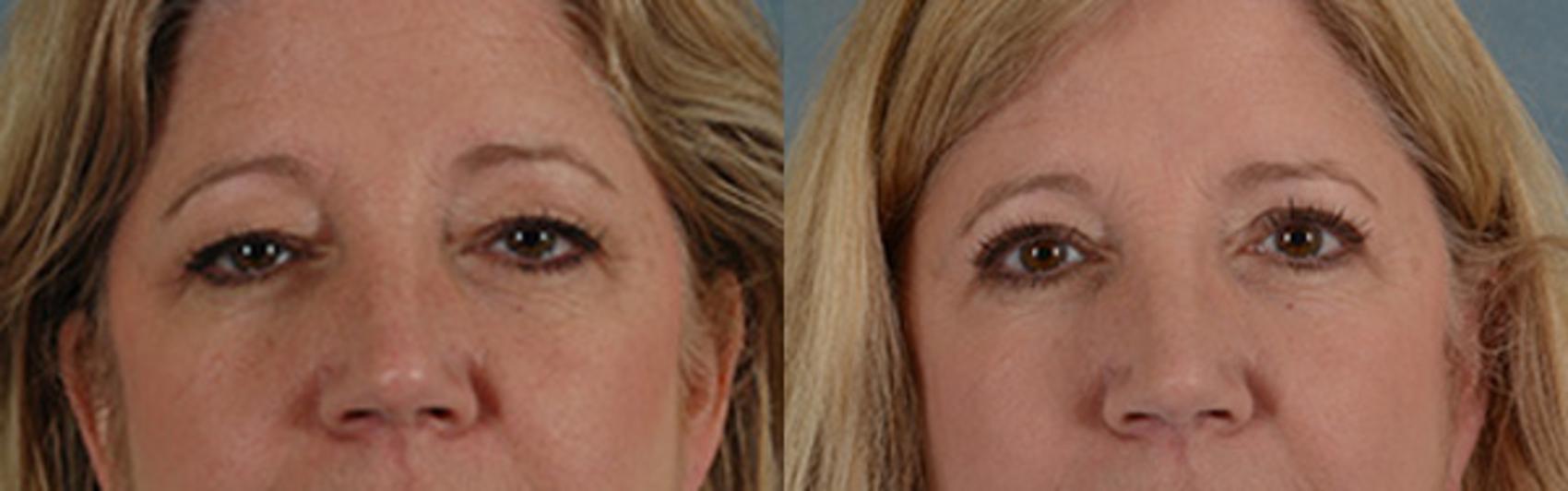 Before & After Eyelid Surgery (Blepharoplasty) Case 43 View #1 View in Tallahassee, FL