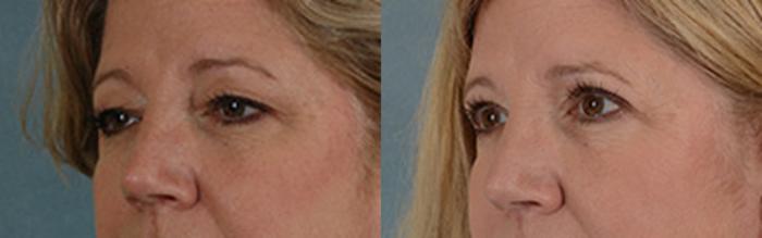 Before & After Eyelid Surgery (Blepharoplasty) Case 43 View #2 View in Tallahassee, FL