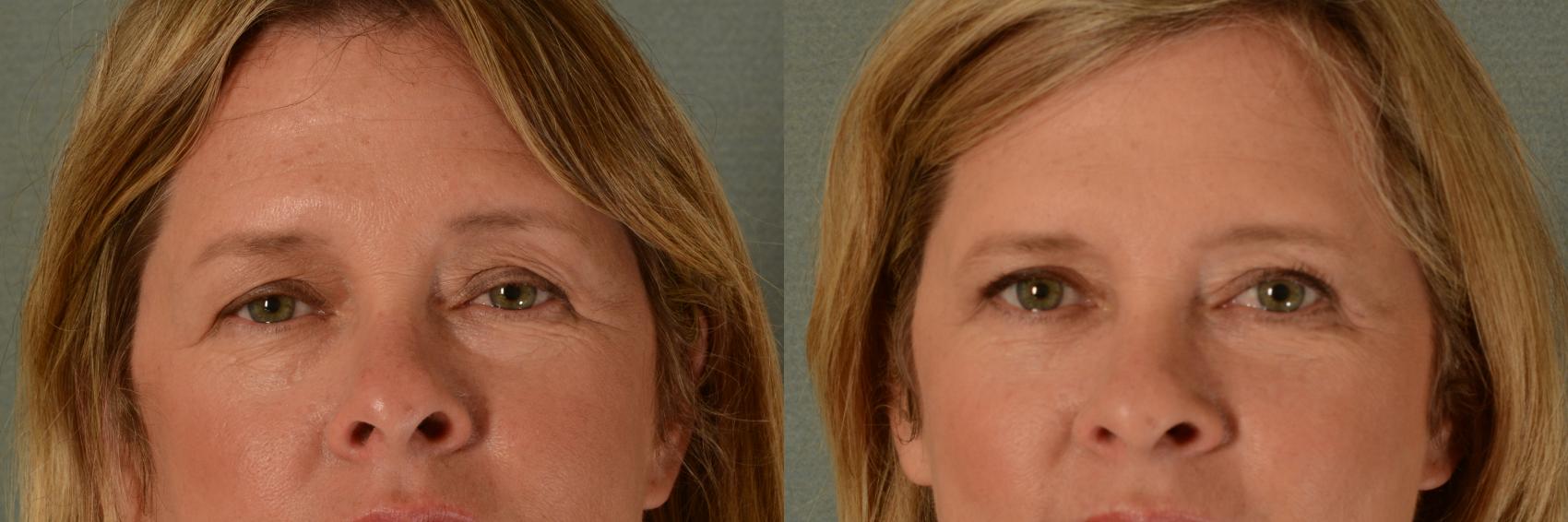 Before & After Eyelid Surgery (Blepharoplasty) Case 437 Front View in Tallahassee, FL