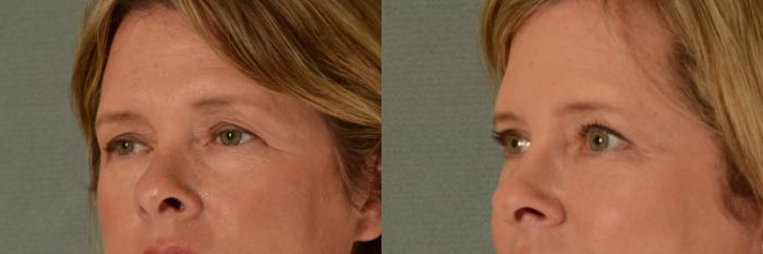 Before & After Eyelid Surgery (Blepharoplasty) Case 437 Left Oblique View in Tallahassee, FL