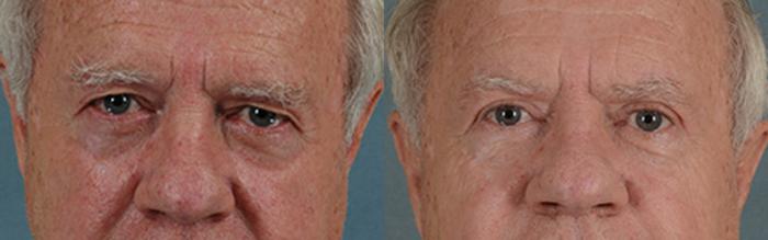 Before & After Eyelid Surgery (Blepharoplasty) Case 44 View #1 View in Tallahassee, FL