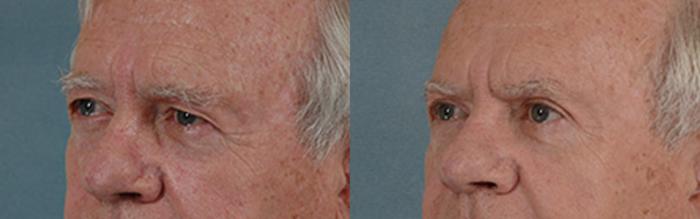 Before & After Eyelid Surgery (Blepharoplasty) Case 44 View #2 View in Tallahassee, FL