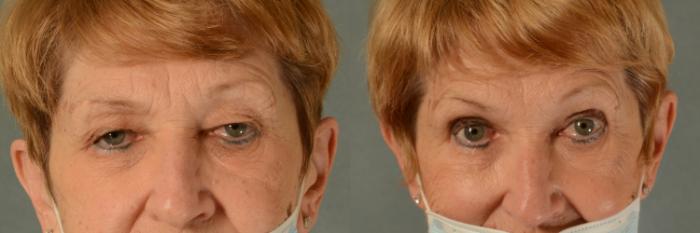 Before & After Eyelid Surgery (Blepharoplasty) Case 442 Front View in Tallahassee, FL