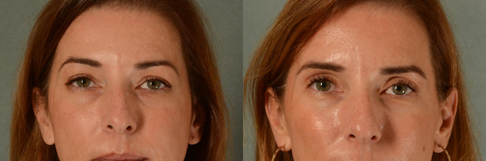 Before & After Eyelid Surgery (Blepharoplasty) Case 443 Front View in Tallahassee, FL