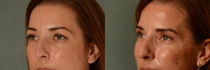 Before & After Eyelid Surgery (Blepharoplasty) Case 443 Left Oblique View in Tallahassee, FL