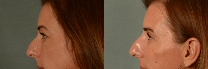 Before & After Eyelid Surgery (Blepharoplasty) Case 443 Left Side View in Tallahassee, FL
