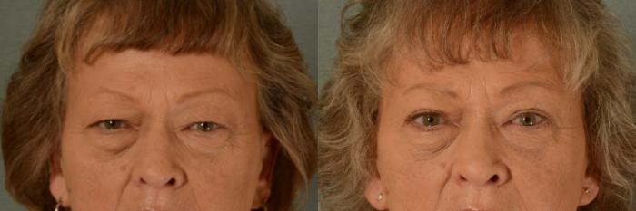 Before & After Eyelid Surgery (Blepharoplasty) Case 446 Front View in Tallahassee, FL