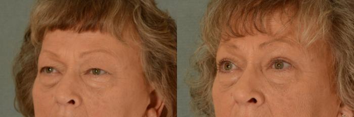 Before & After Eyelid Surgery (Blepharoplasty) Case 446 Left Oblique View in Tallahassee, FL