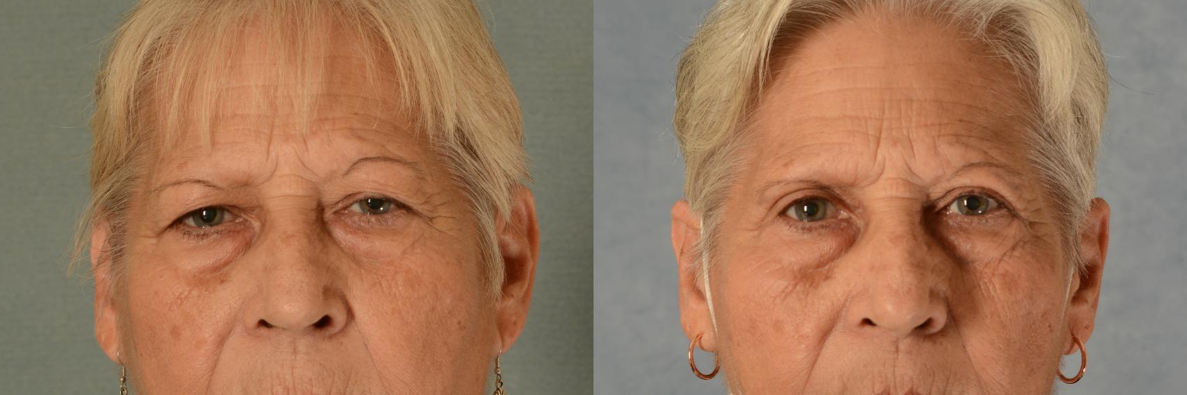 Before & After Eyelid Surgery (Blepharoplasty) Case 451 Front View in Tallahassee, FL