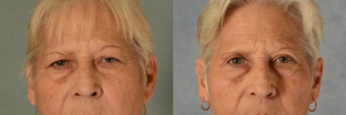 Before & After Eyelid Surgery (Blepharoplasty) Case 451 Front View in Tallahassee, FL