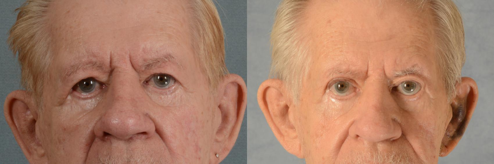 Before & After Eyelid Surgery (Blepharoplasty) Case 457 Front View in Tallahassee, FL