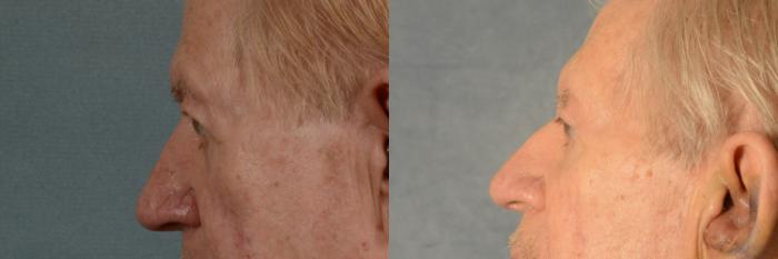 Before & After Eyelid Surgery (Blepharoplasty) Case 457 Left Side View in Tallahassee, FL