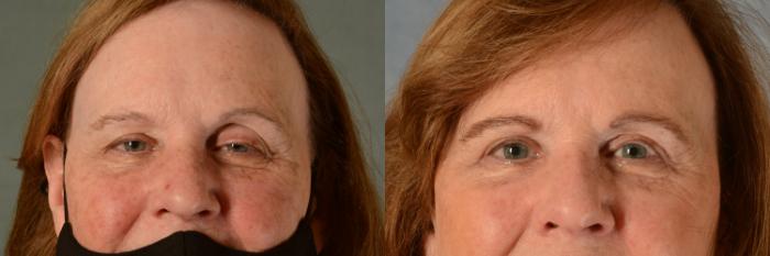 Before & After Eyelid Surgery (Blepharoplasty) Case 458 Front View in Tallahassee, FL