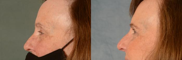 Before & After Eyelid Surgery (Blepharoplasty) Case 458 Left Side View in Tallahassee, FL