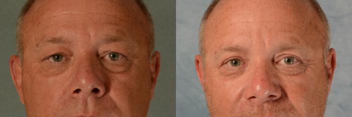 Before & After Eyelid Surgery (Blepharoplasty) Case 459 Front View in Tallahassee, FL