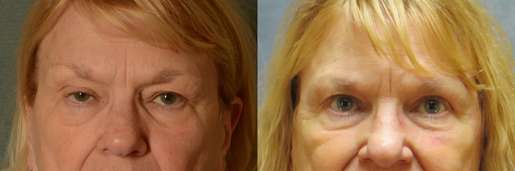 Before & After Eyelid Surgery (Blepharoplasty) Case 463 Front View in Tallahassee, FL