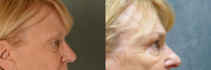 Before & After Eyelid Surgery (Blepharoplasty) Case 463 Left Side View in Tallahassee, FL