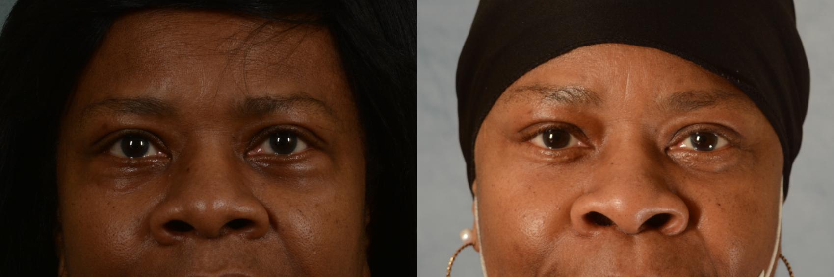 Before & After Eyelid Surgery (Blepharoplasty) Case 464 Front View in Tallahassee, FL