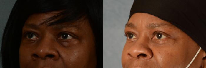 Before & After Eyelid Surgery (Blepharoplasty) Case 464 Left Oblique View in Tallahassee, FL