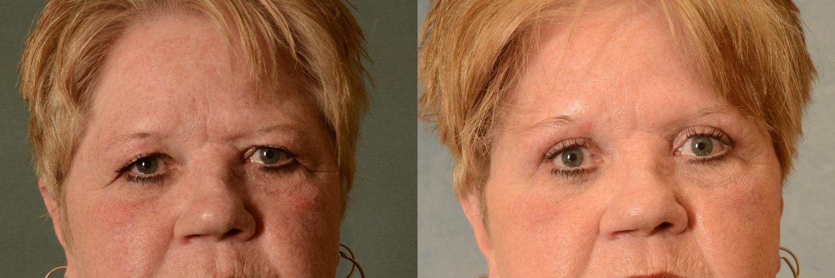Before & After Eyelid Surgery (Blepharoplasty) Case 465 Front View in Tallahassee, FL