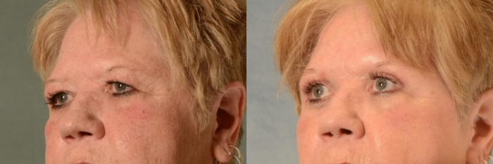 Before & After Eyelid Surgery (Blepharoplasty) Case 465 Left Oblique View in Tallahassee, FL