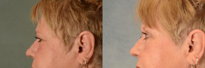 Before & After Eyelid Surgery (Blepharoplasty) Case 465 Left Side View in Tallahassee, FL