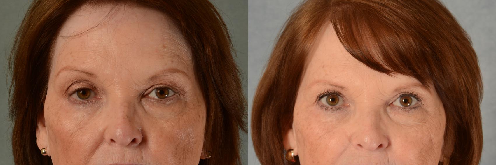 Before & After Eyelid Surgery (Blepharoplasty) Case 466 Front View in Tallahassee, FL
