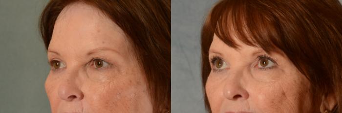 Before & After Eyelid Surgery (Blepharoplasty) Case 466 Left Oblique View in Tallahassee, FL