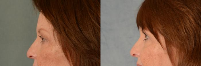 Before & After Eyelid Surgery (Blepharoplasty) Case 466 Left Side View in Tallahassee, FL
