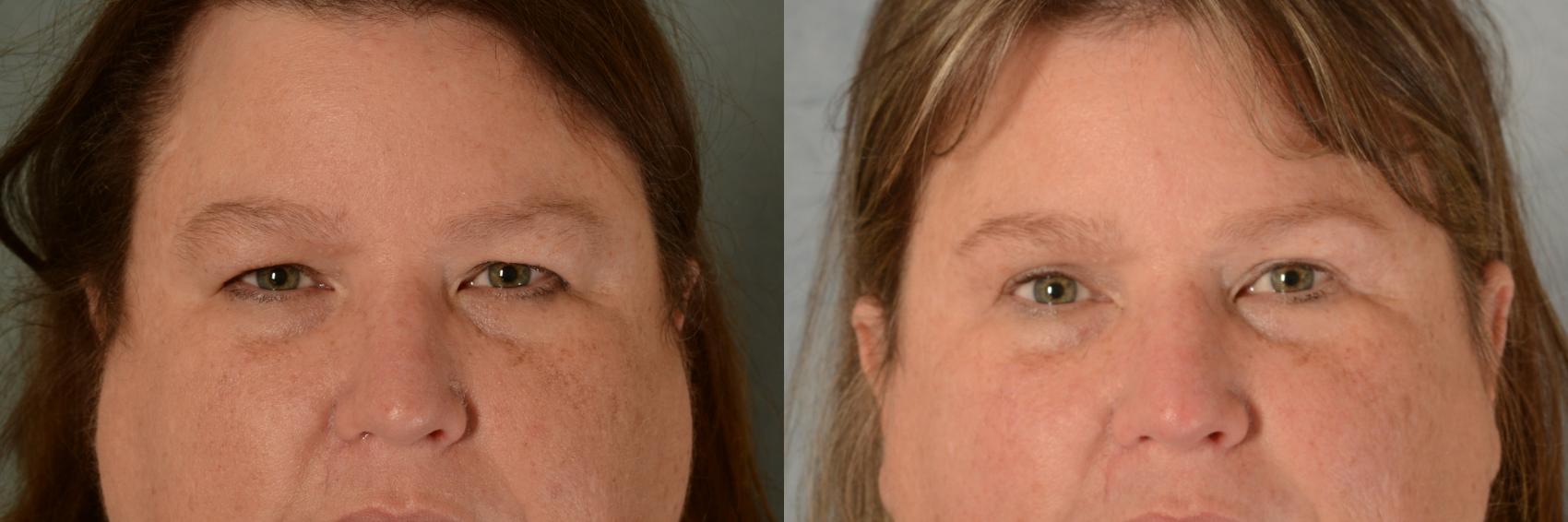 Before & After Eyelid Surgery (Blepharoplasty) Case 473 Front View in Tallahassee, FL