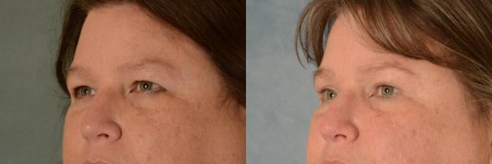 Before & After Eyelid Surgery (Blepharoplasty) Case 473 Left Oblique View in Tallahassee, FL