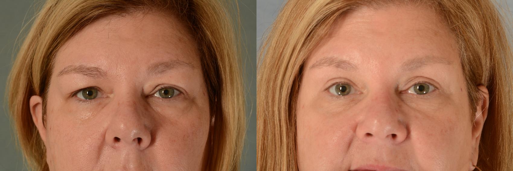 Before & After Eyelid Surgery (Blepharoplasty) Case 480 Front View in Tallahassee, FL