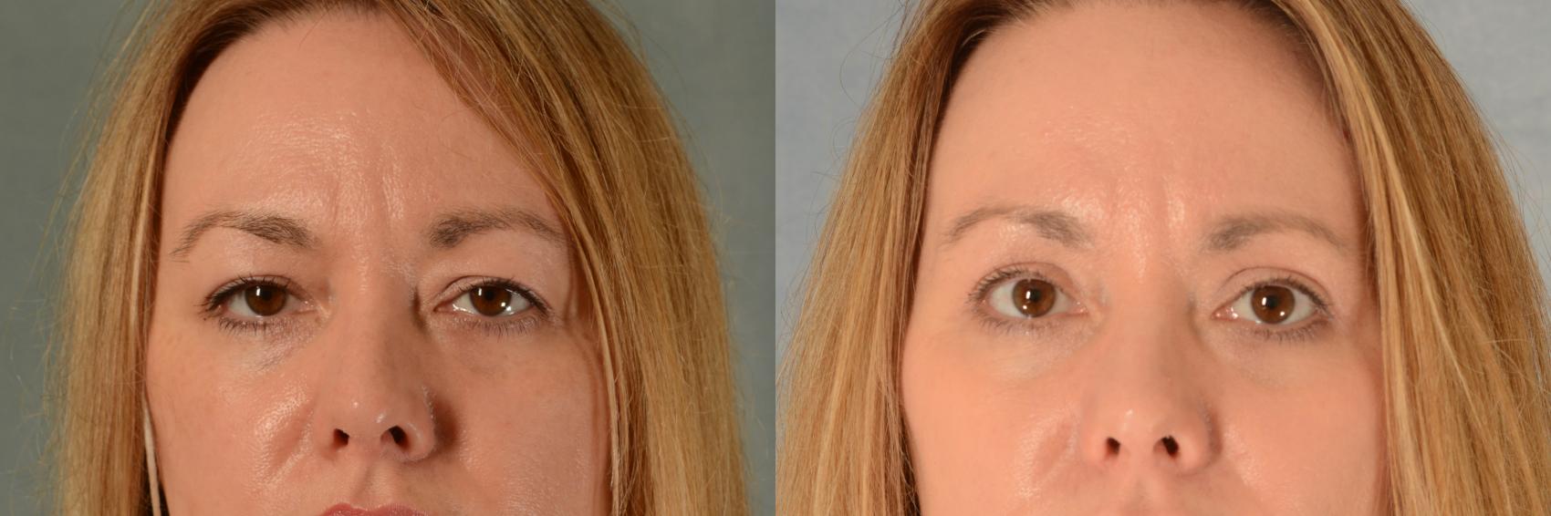 Before & After Eyelid Surgery (Blepharoplasty) Case 482 Front View in Tallahassee, FL