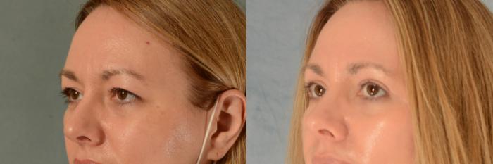 Before & After Eyelid Surgery (Blepharoplasty) Case 482 Left Oblique View in Tallahassee, FL