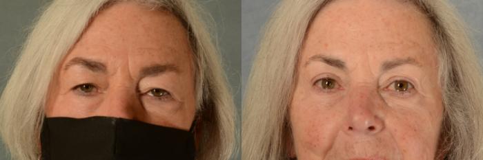 Before & After Eyelid Surgery (Blepharoplasty) Case 487 Front View in Tallahassee, FL