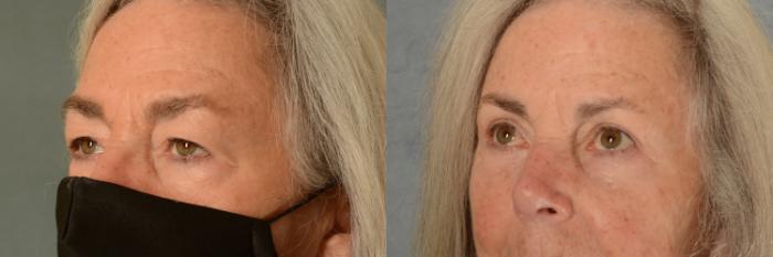 Before & After Eyelid Surgery (Blepharoplasty) Case 487 Left Oblique View in Tallahassee, FL