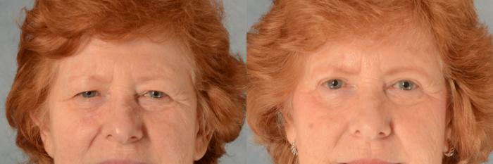 Before & After Eyelid Surgery (Blepharoplasty) Case 496 Front View in Tallahassee, FL