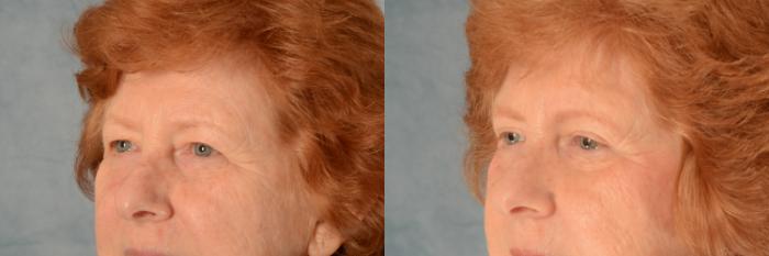Before & After Eyelid Surgery (Blepharoplasty) Case 496 Left Oblique View in Tallahassee, FL