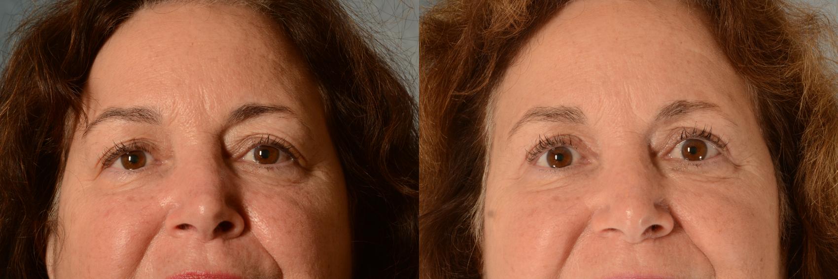 Before & After Eyelid Surgery (Blepharoplasty) Case 501 Front View in Tallahassee, FL