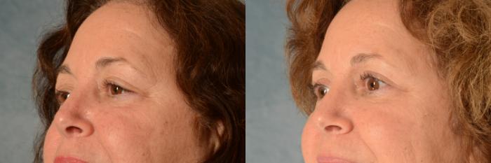 Before & After Eyelid Surgery (Blepharoplasty) Case 501 Left Oblique View in Tallahassee, FL