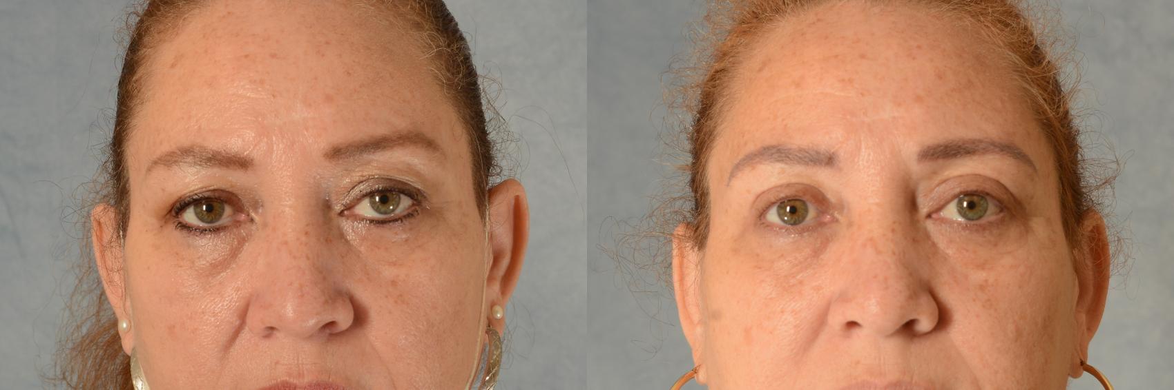 Before & After Eyelid Surgery (Blepharoplasty) Case 502 Front View in Tallahassee, FL