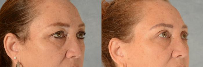 Before & After Eyelid Surgery (Blepharoplasty) Case 502 Right Oblique View in Tallahassee, FL