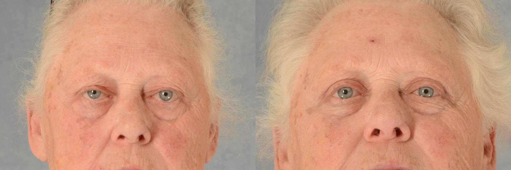 Before & After Eyelid Surgery (Blepharoplasty) Case 503 Front View in Tallahassee, FL