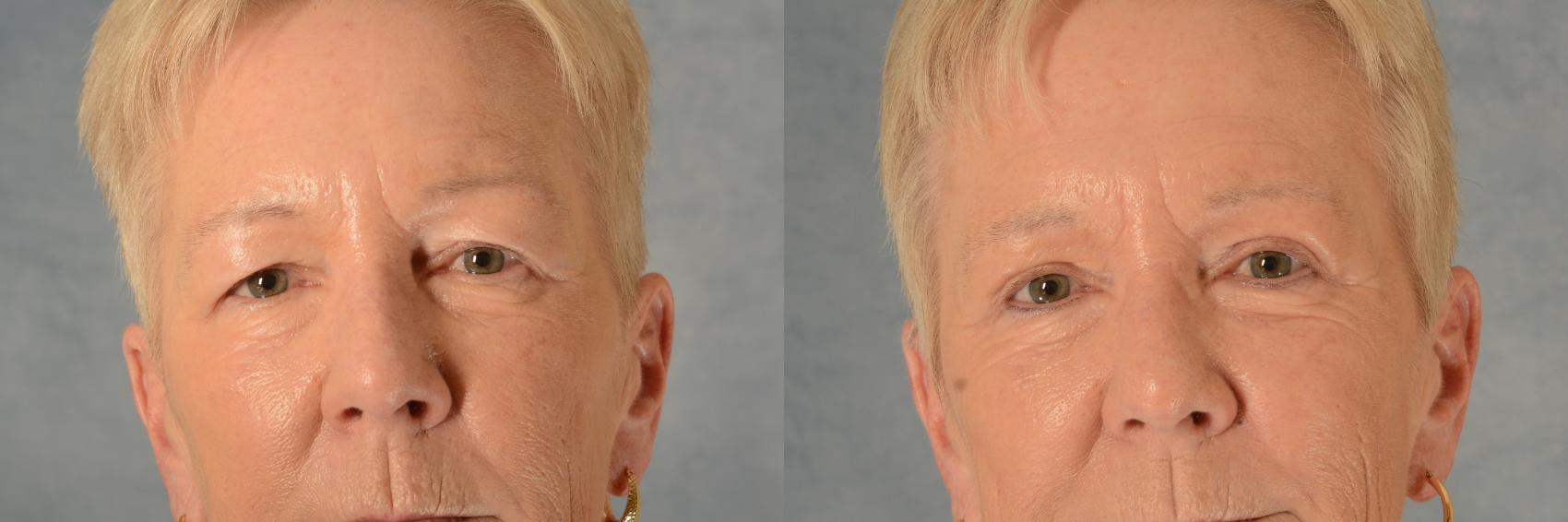 Before & After Eyelid Surgery (Blepharoplasty) Case 504 Front View in Tallahassee, FL