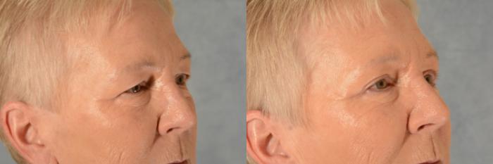 Before & After Eyelid Surgery (Blepharoplasty) Case 504 Right Oblique View in Tallahassee, FL
