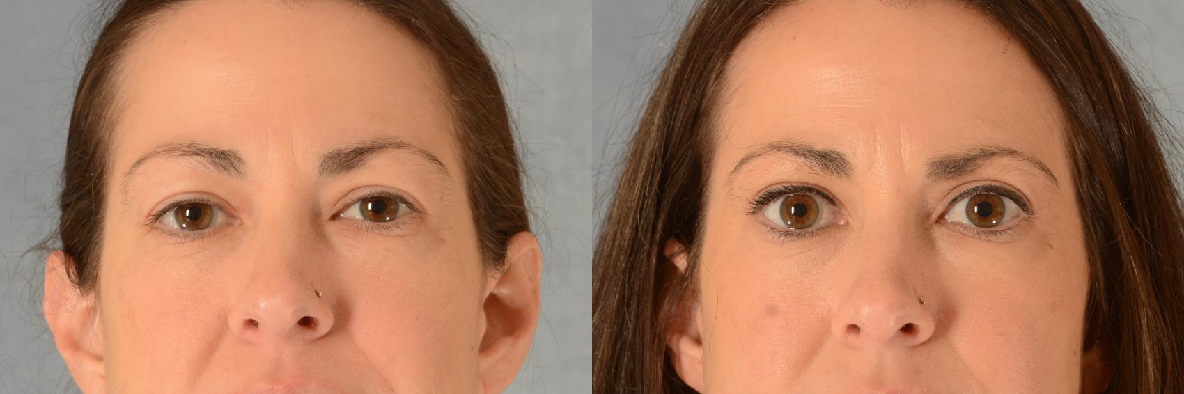 Before & After Eyelid Surgery (Blepharoplasty) Case 511 Front View in Tallahassee, FL